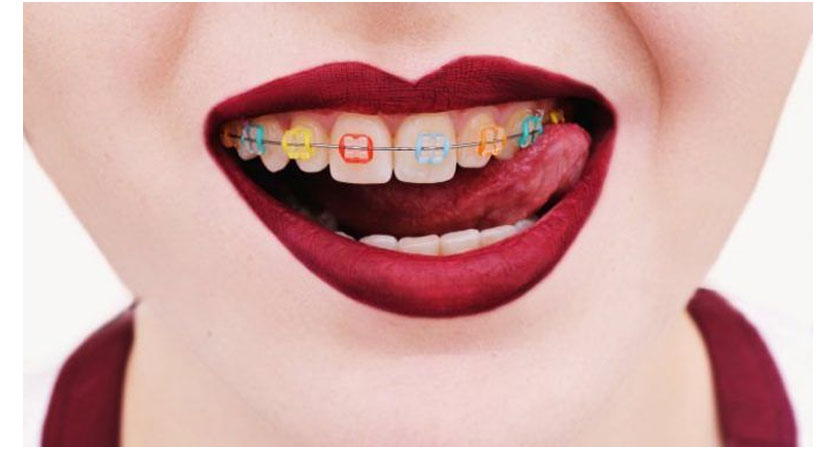 braces colors for Girls