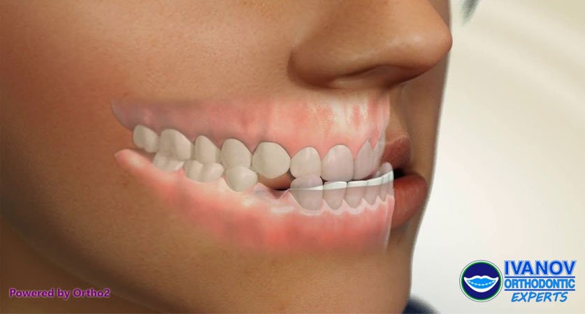 underbite correction