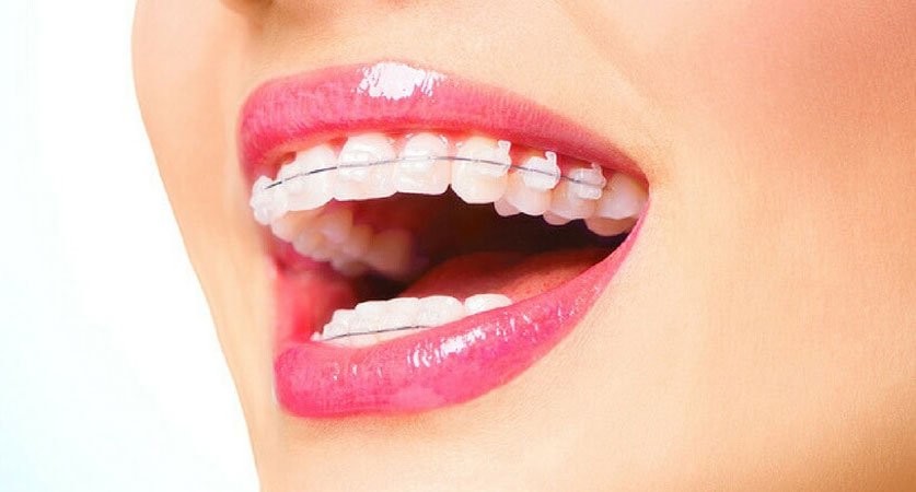 Invisalign clear aligners