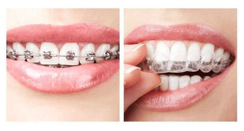 Invisalign doctors near me