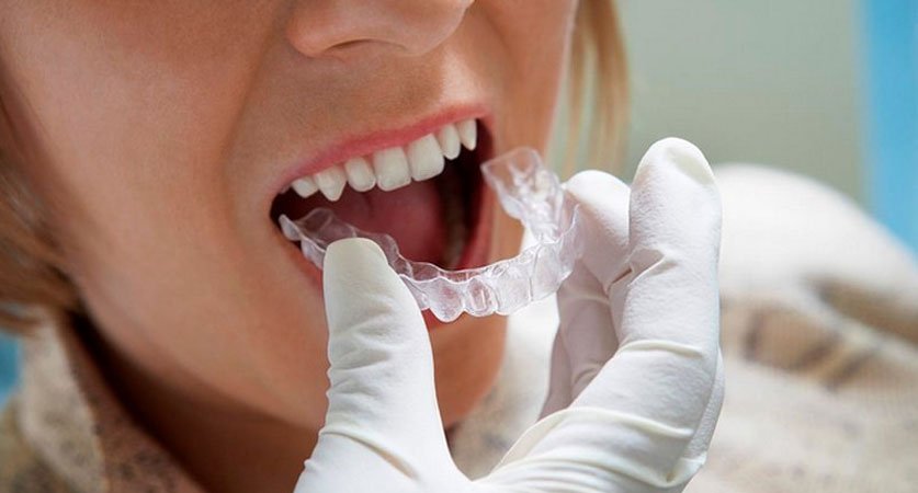 Invisalign Dentist