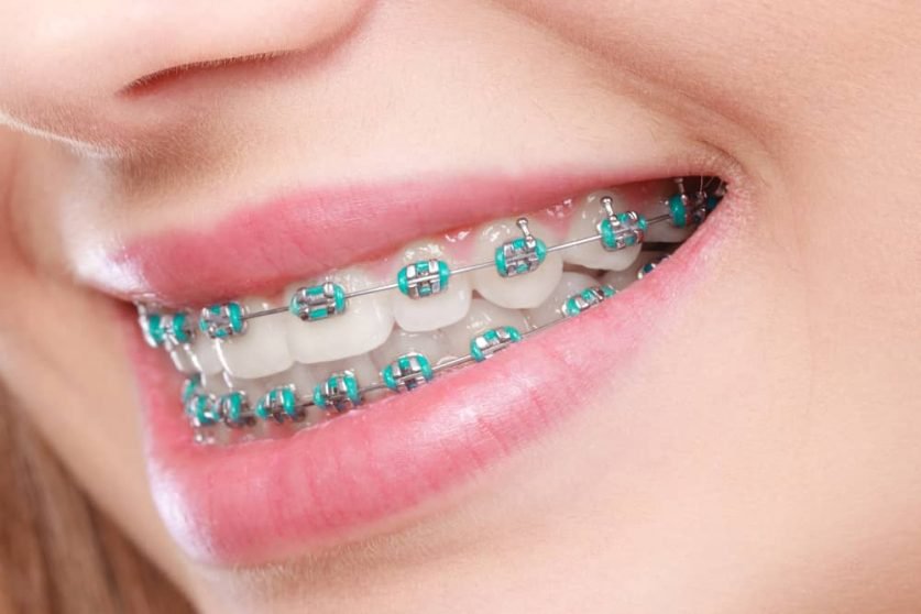 braces colors