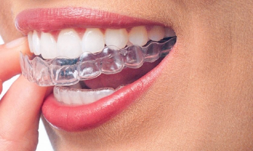 Invisalign Treatment