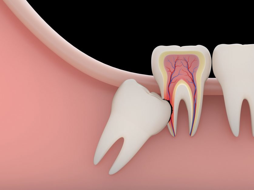 Wisdom Tooth Extraction