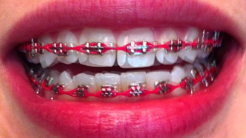 Braces Colors