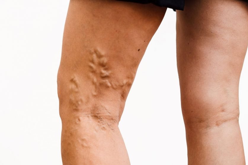 varicose vein