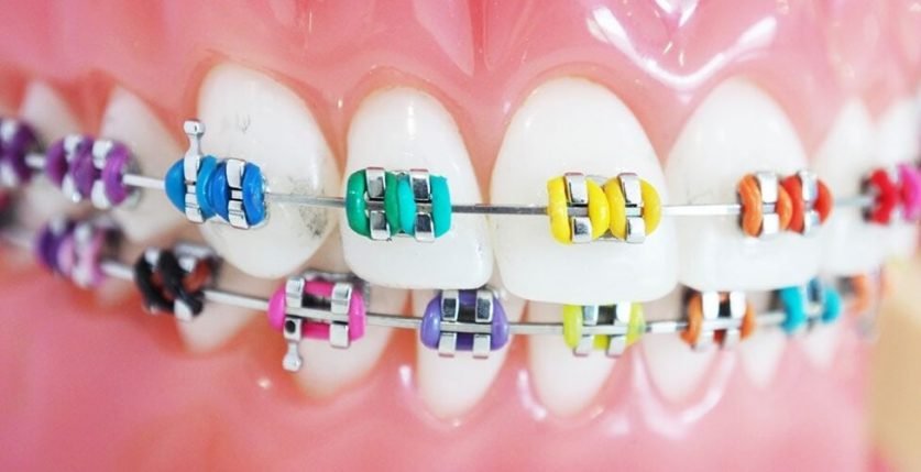 best braces colors to get