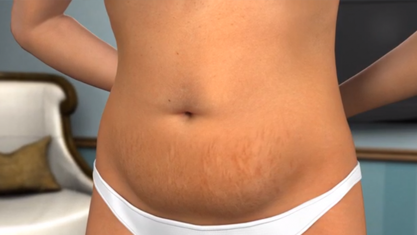 Tummy Tuck