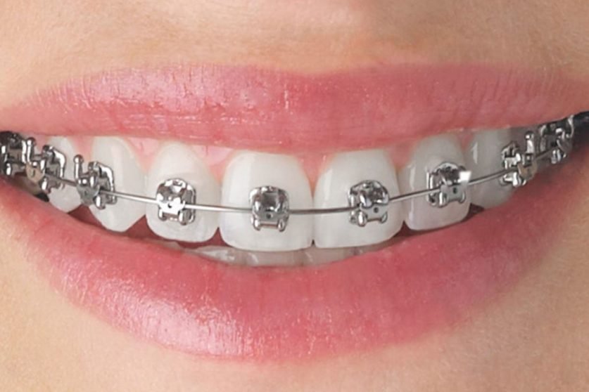 Dental Braces