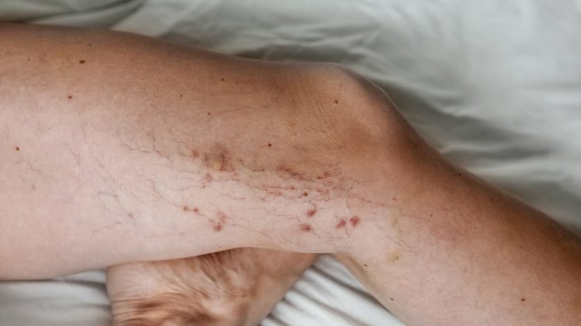 Varicose Veins