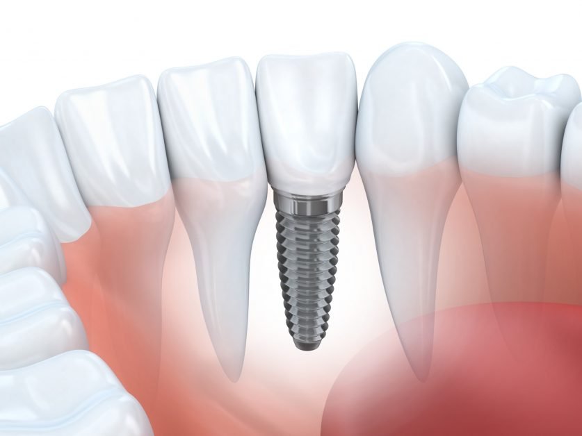 Root Canal Treatment