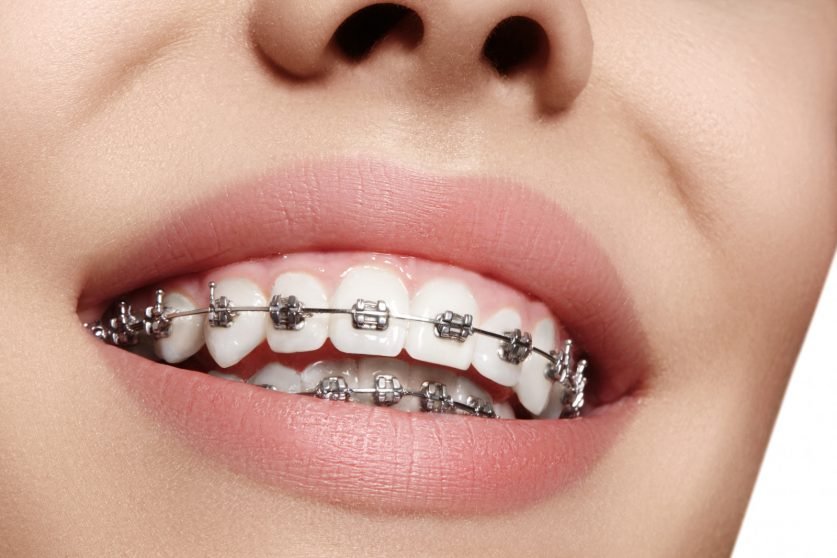 Braces Treatment