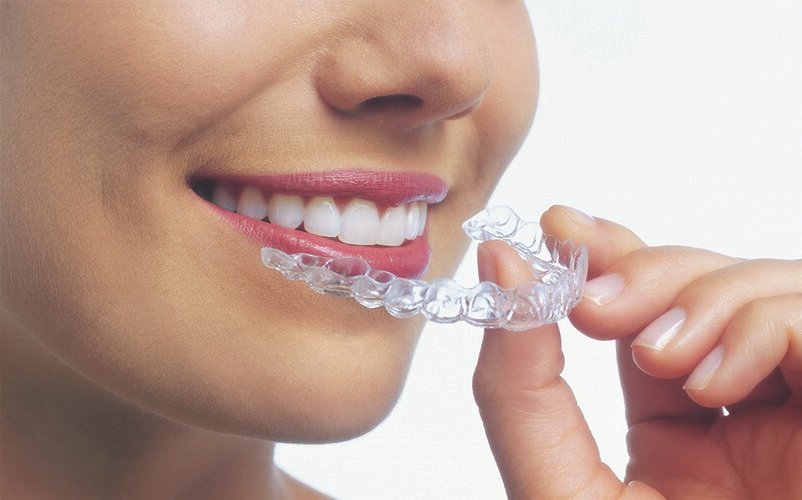 Invisalign Treatment