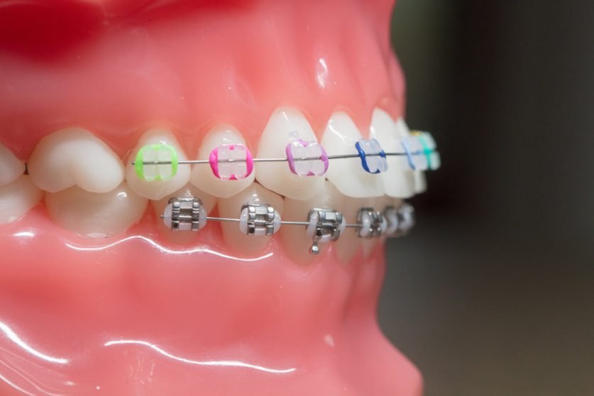 braces colors