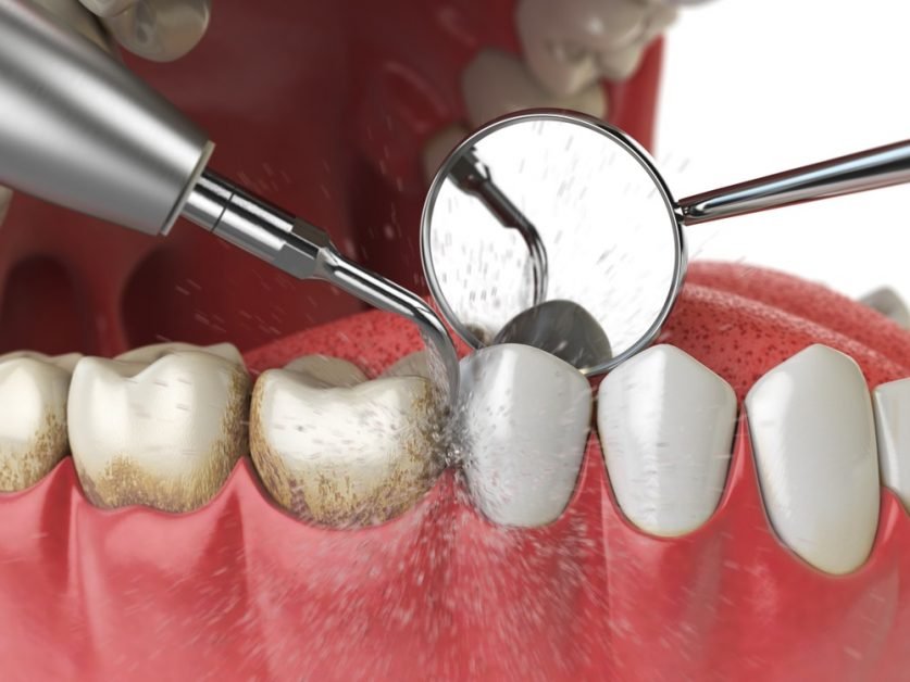 deep cleaning teeth