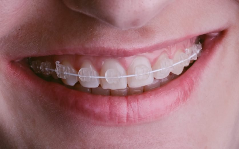 Kids Braces