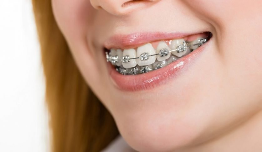 overbite braces