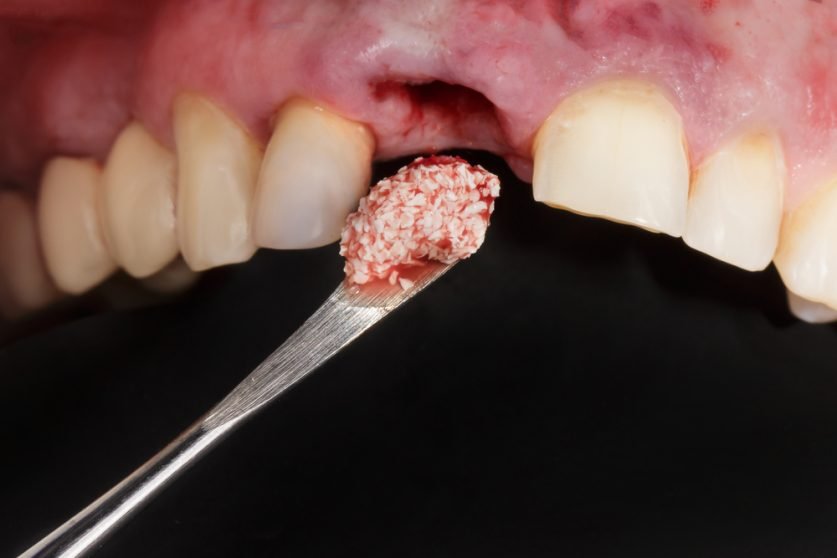 bone graft