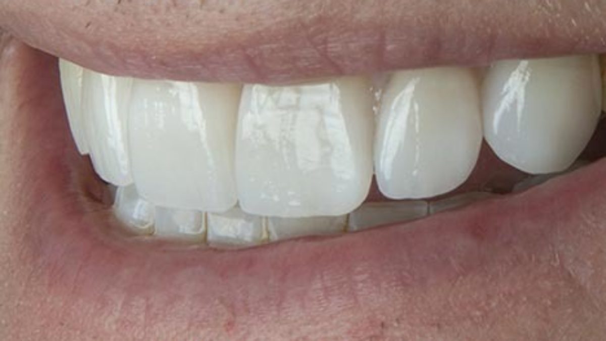 braces before veneers