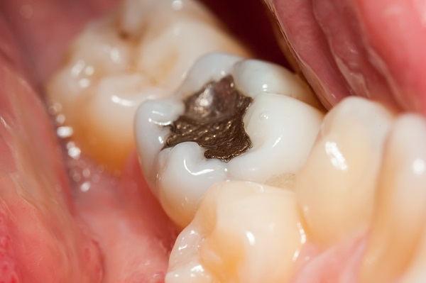 tooth cavity filling