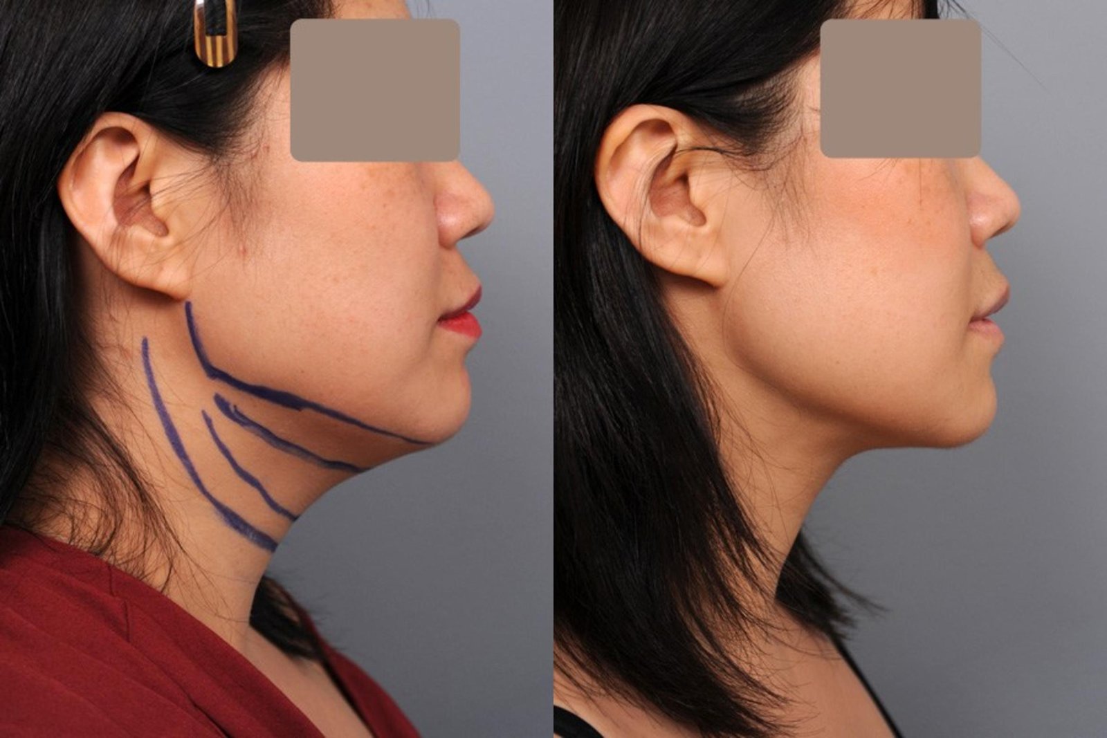 Neck Liposuction