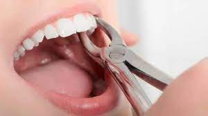 tooth extraction Houston
