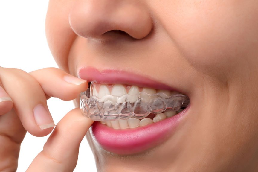 Comfort dental braces