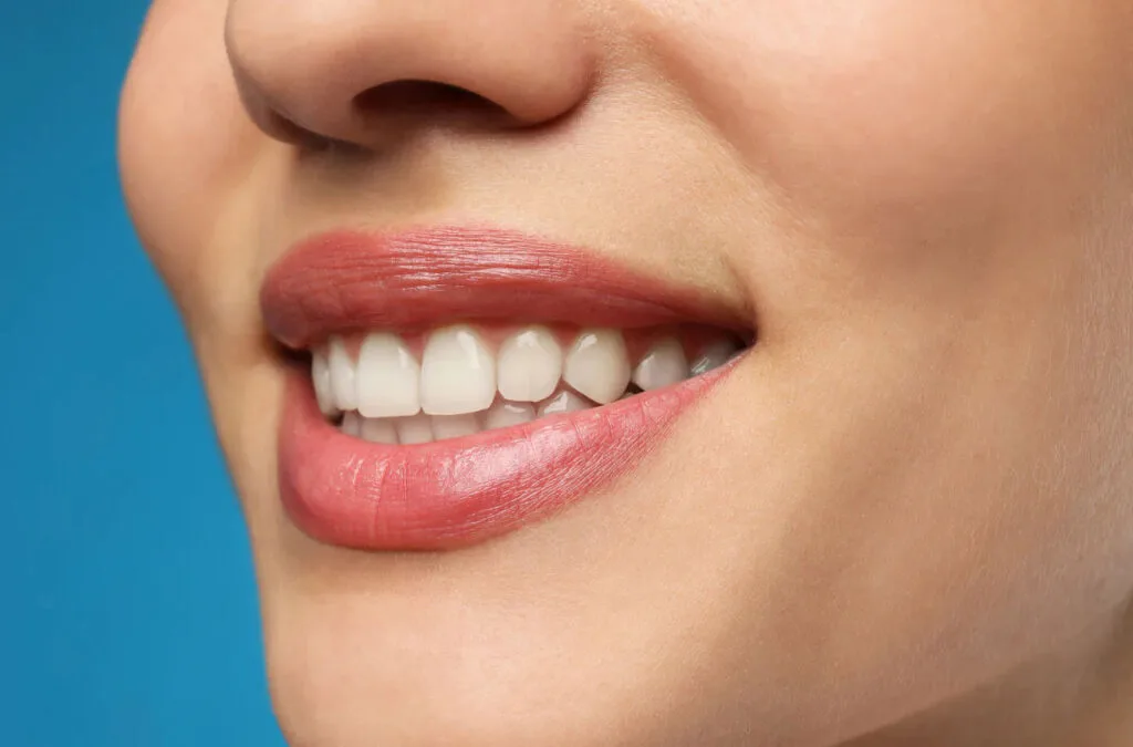 best veneers houston