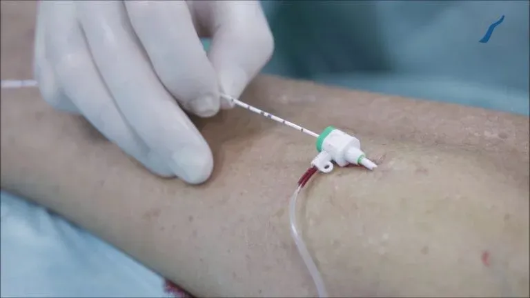 Varicose veins treatment in Bilaspur Chhattisgarh