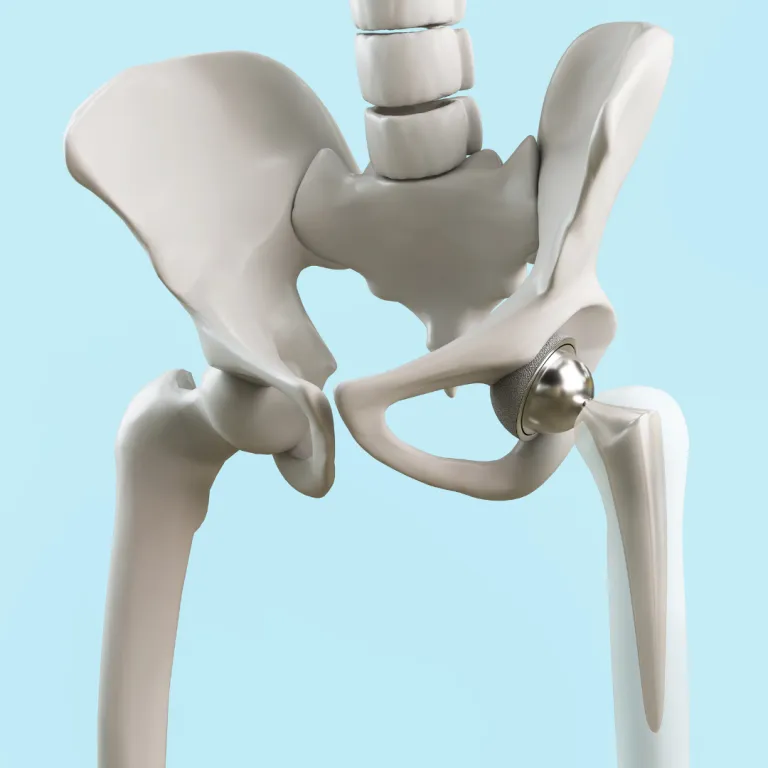 Joint replacement treatment in bilaspur