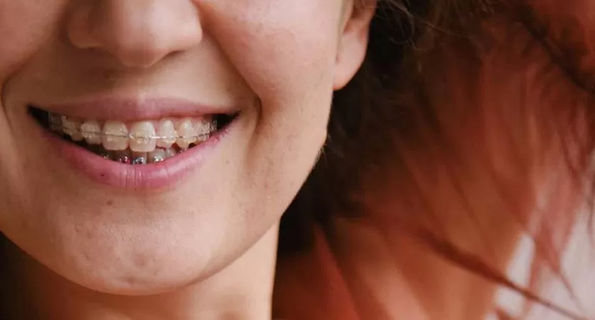 teeth straightening