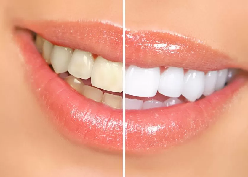 Bleach Teeth