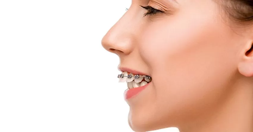 fix overbite