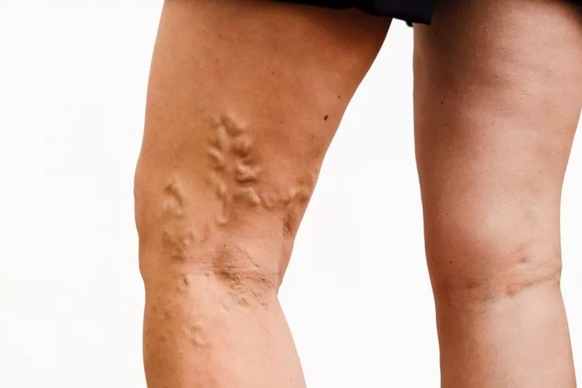 varicose vein