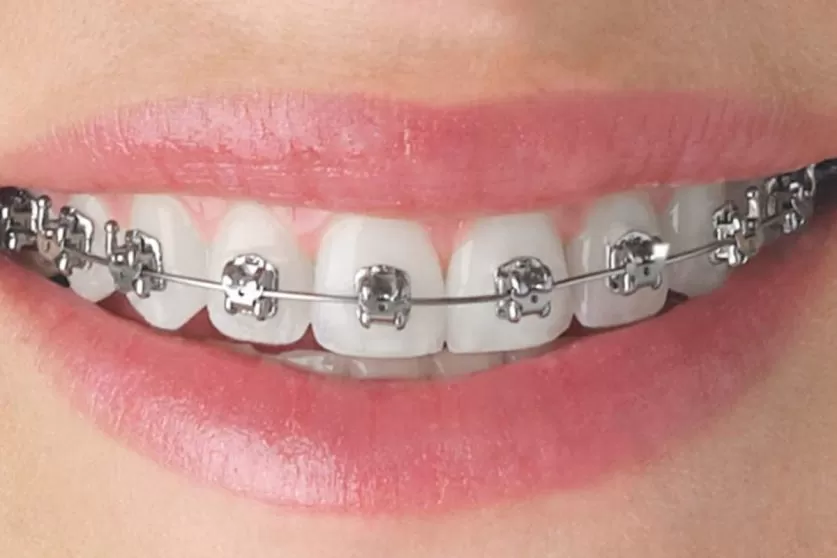 Dental Braces