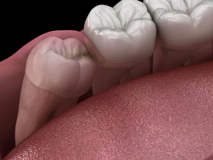 Wisdom Tooth Removal