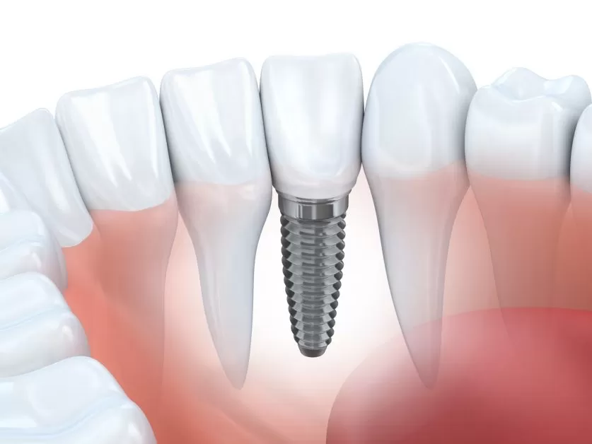Root Canal Treatment