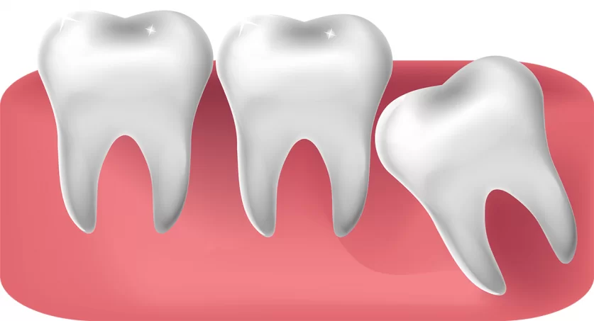 Wisdom Tooth Extraction