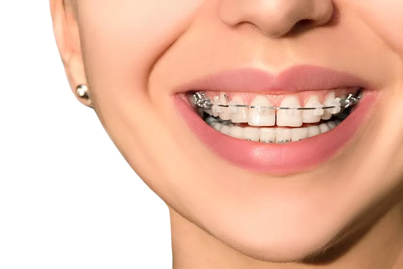 Braces Treatment