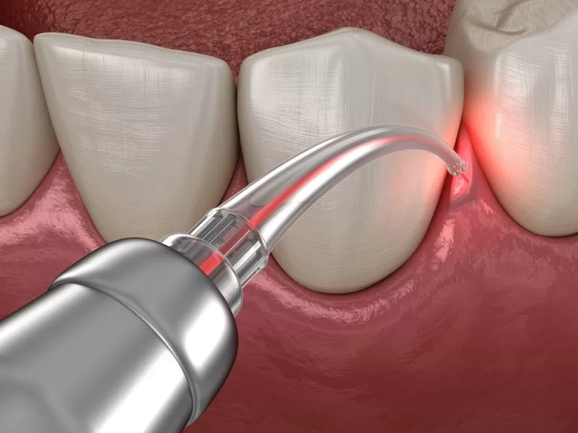 Laser Gum Surgery