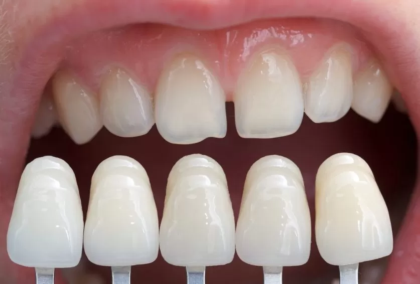 dental veneers