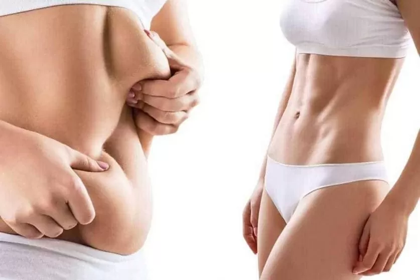 liposuction surgery