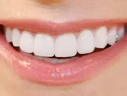 affordable dental bonding near me in Houston